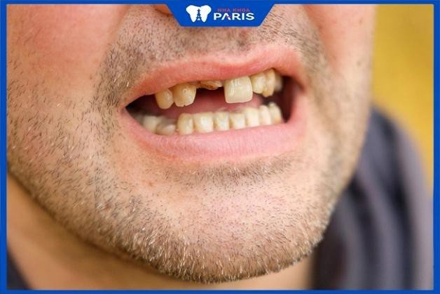 Ảnh minh họa răng cửa bị rụng trong giấc mơ, phản ánh sự mệt mỏi