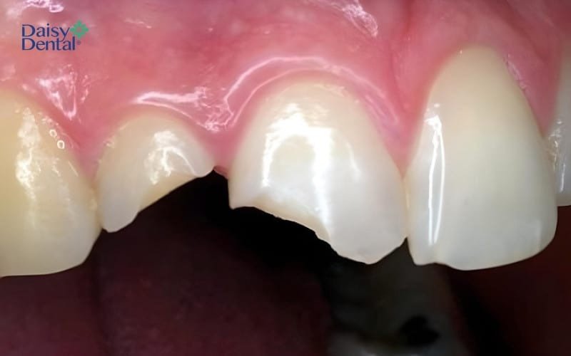 Biểu tượng răng bị mẻ nhưng không chảy máu, minh họa cho một giấc mơ mang điềm lành, sắp gặp quý nhân phù trợ.