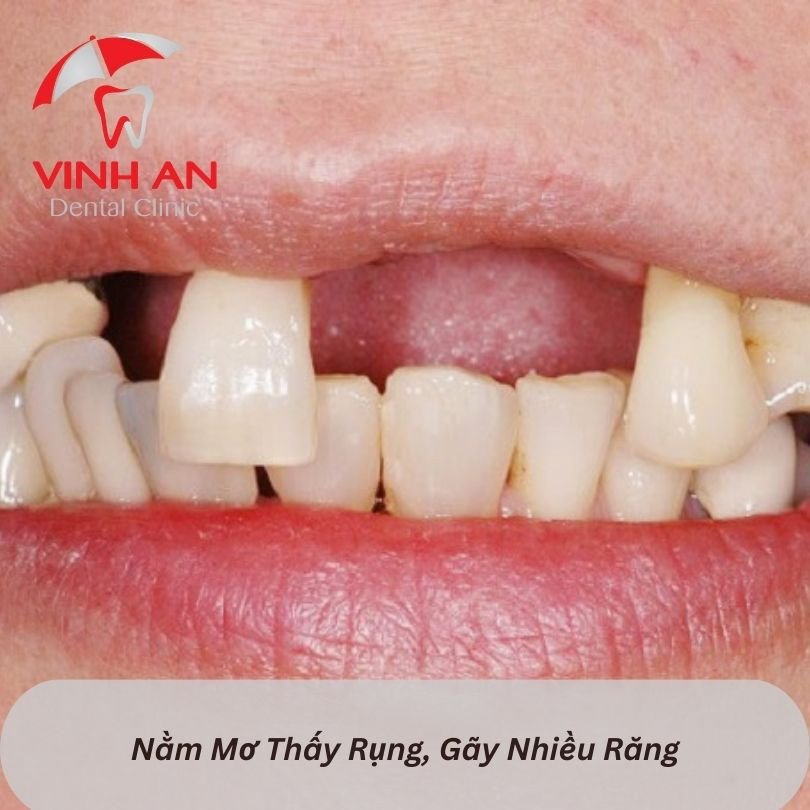 Các con số đặc biệt khi nằm mơ rụng nhiều răng