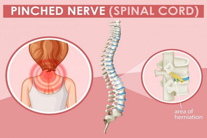 Dấu hiệu đau lưng mãn tính do tổn thương đĩa đệm cần phẫu thuật