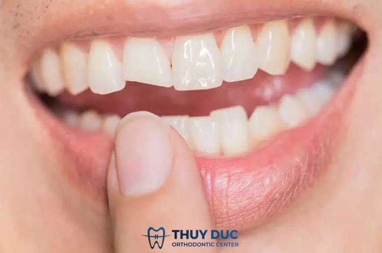 Điềm báo khi mơ thấy mình bị gãy răng không chảy máu