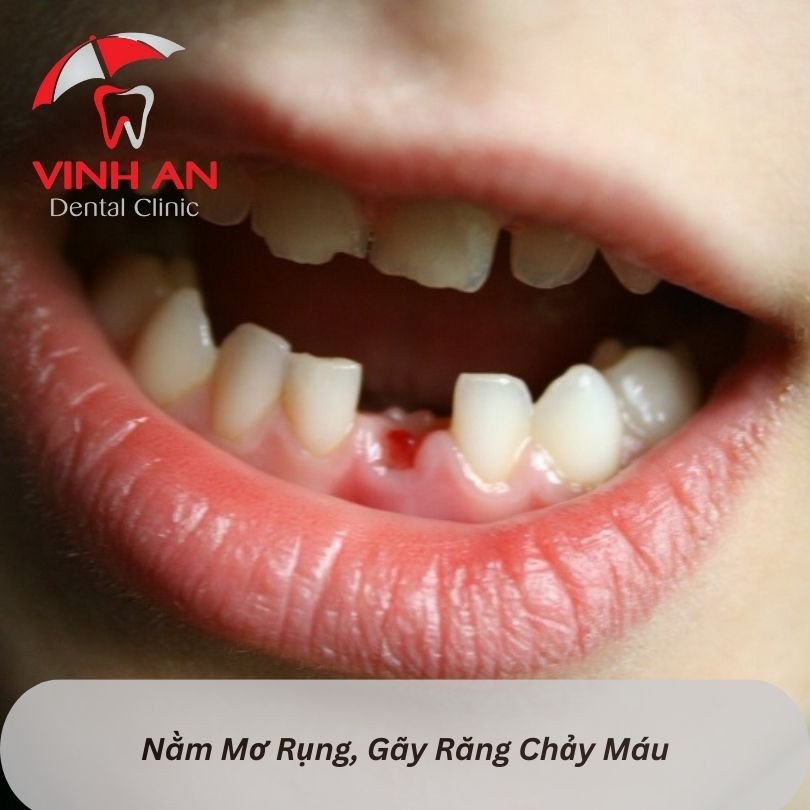 Giấc mơ rụng răng chảy máu: Ý nghĩa và con số