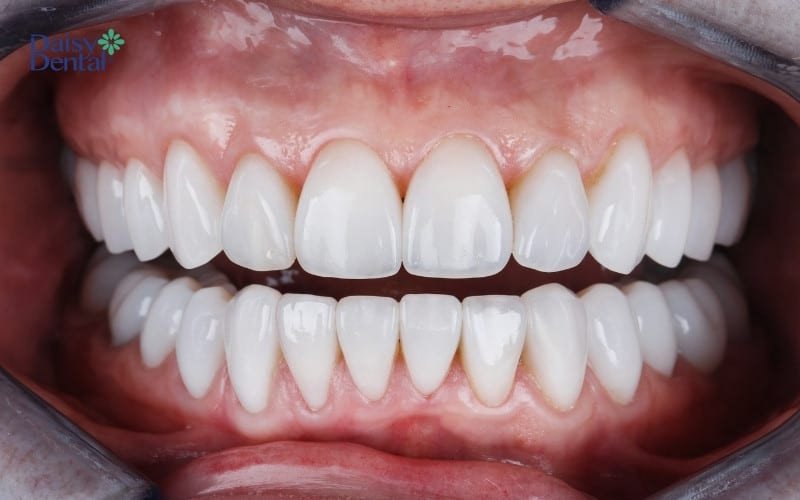 Giấc mơ về hàm răng mới có thể là điềm báo cho những thay đổi tiêu cực sắp tới