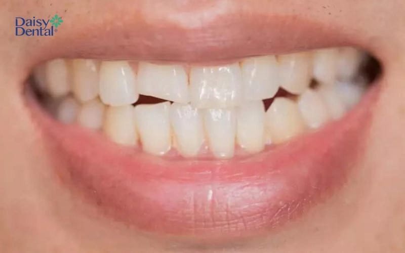 Hai người đang trò chuyện thân mật, minh họa cho việc giải mã giấc mơ thấy người khác bị mẻ răng phụ thuộc vào mối quan hệ.