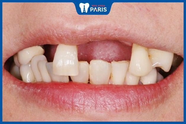 Hàm răng trên bị rụng, thể hiện điềm báo trong giấc mơ rụng nhiều răng