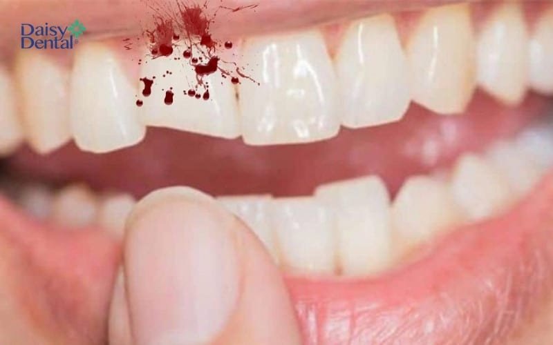 Hình ảnh chiếc răng bị mẻ và chảy máu, tượng trưng cho những khó khăn, tai họa hoặc mất mát tài chính sắp đến trong giấc mơ.