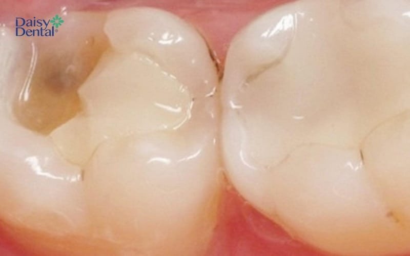 Hình ảnh chiếc răng hàm số 6 bị mẻ, tượng trưng cho những điềm báo nghiêm trọng liên quan đến người thân hoặc mối quan hệ.
