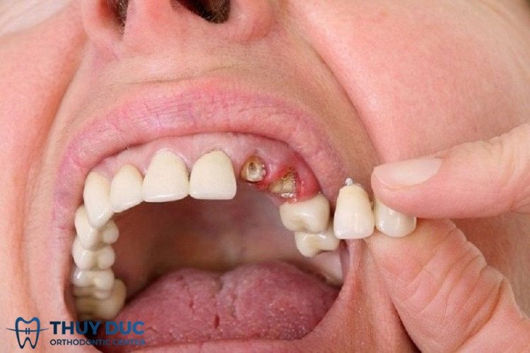 Hình ảnh hàm răng trên bị rụng trong giấc mơ, tượng trưng cho những khó khăn sắp tới.