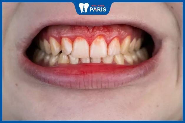 Hình ảnh một chiếc răng lung lay và chảy máu, biểu tượng cho điềm báo xấu trong giấc mơ.