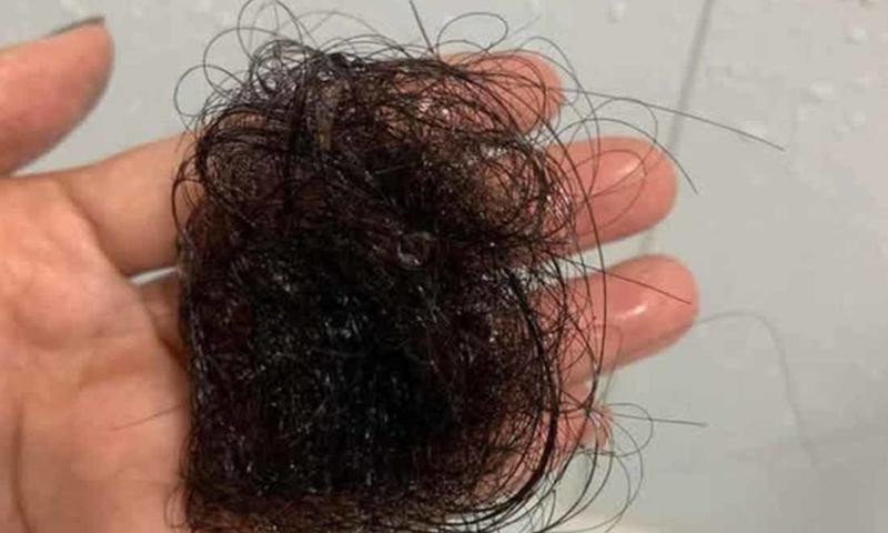 Hình ảnh một người đàn ông lo lắng vì tóc rụng nhiều trong giấc mơ
