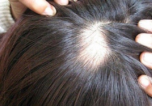 Hình ảnh vùng da đầu bị hói, thể hiện sự lo lắng về mơ thấy bị hói đầu nghiêm trọng