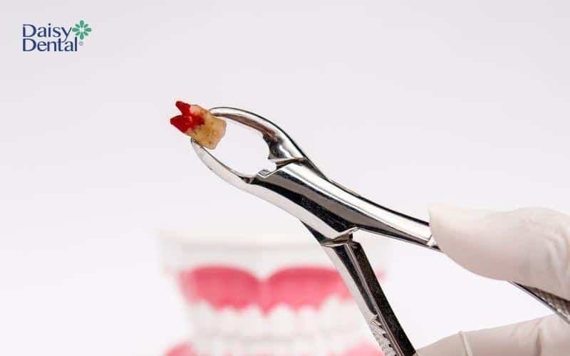 Mơ nhổ răng chảy máu báo hiệu sự rạn nứt của các mối quan hệ, bao gồm gia đình