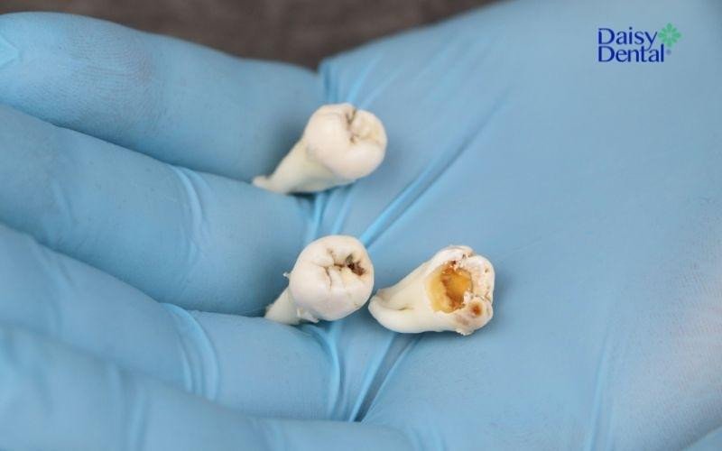 Mơ rụng 3 răng không chảy máu: điềm báo về mối quan hệ hoặc người thân