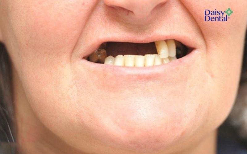 Mơ thấy người lạ hoặc người quen rụng răng: điềm báo cần cẩn trọng