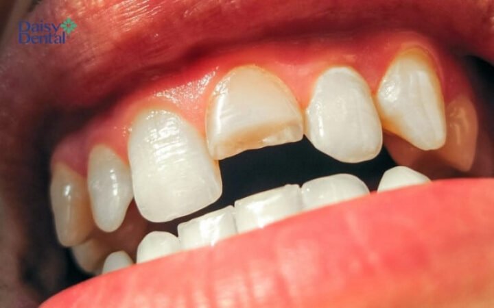 Nằm mơ thấy răng cửa hàm trên bị mẻ là dấu hiệu bạn sắp gặp phải vấn đề tài chính