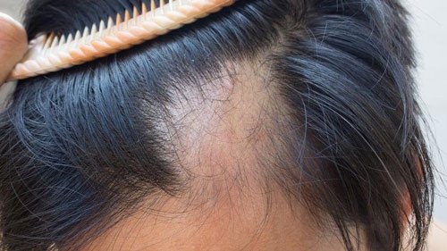 Người phụ nữ bới tóc, tóc rụng nhiều trên lược, tượng trưng cho giấc mơ rụng tóc nhiều là điềm gì