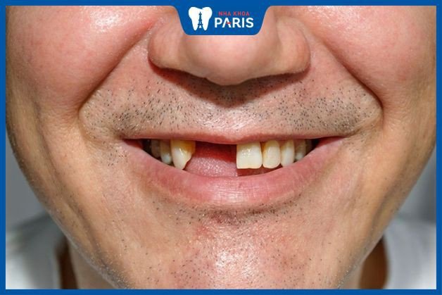 Người phụ nữ lo lắng khi mơ thấy rụng hai chiếc răng