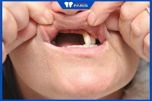 Người phụ nữ lo lắng khi nằm mơ thấy rụng nhiều răng không chảy máu