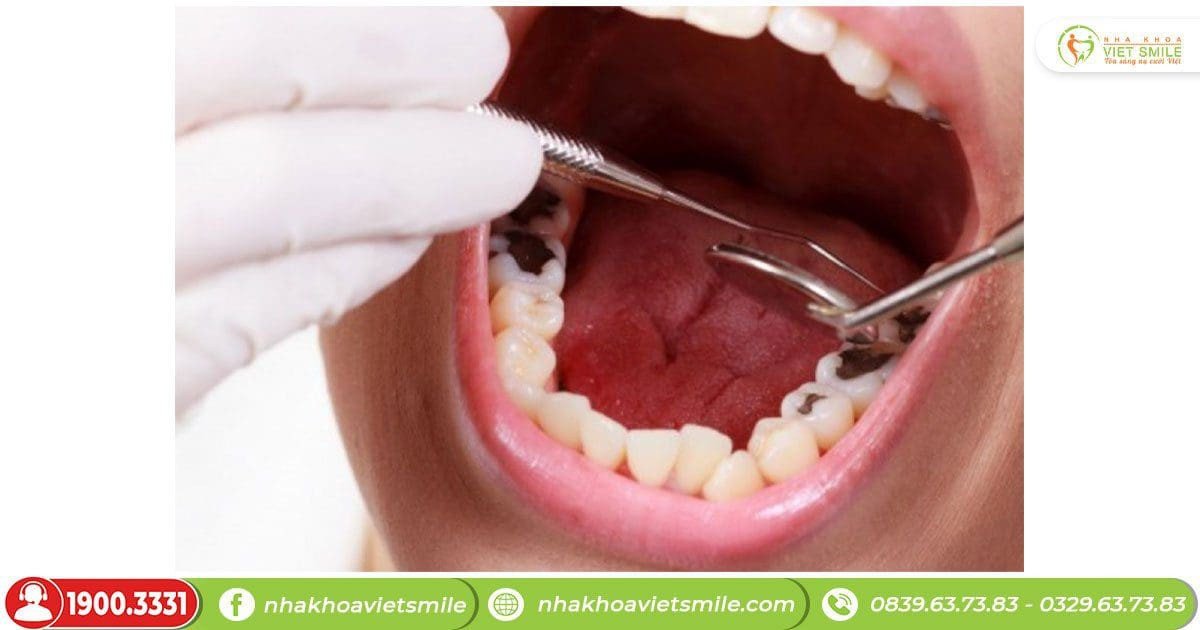 Thăm khám nha sĩ để kiểm tra sức khỏe răng miệng khi thường xuyên mơ thấy gãy răng
