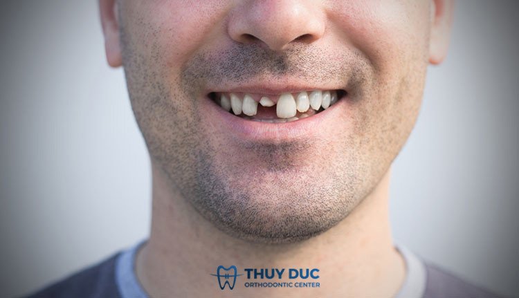 Ý nghĩa chi tiết khi mơ thấy mình bị gãy răng cửa