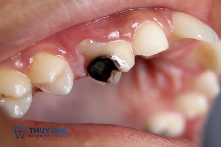 Ý nghĩa của giấc mơ gãy răng sâu và chuyển biến