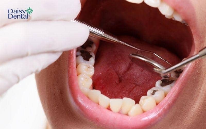 Ý nghĩa điềm báo khi mơ thấy nhổ răng sâu cho con, liên quan đến tài lộc