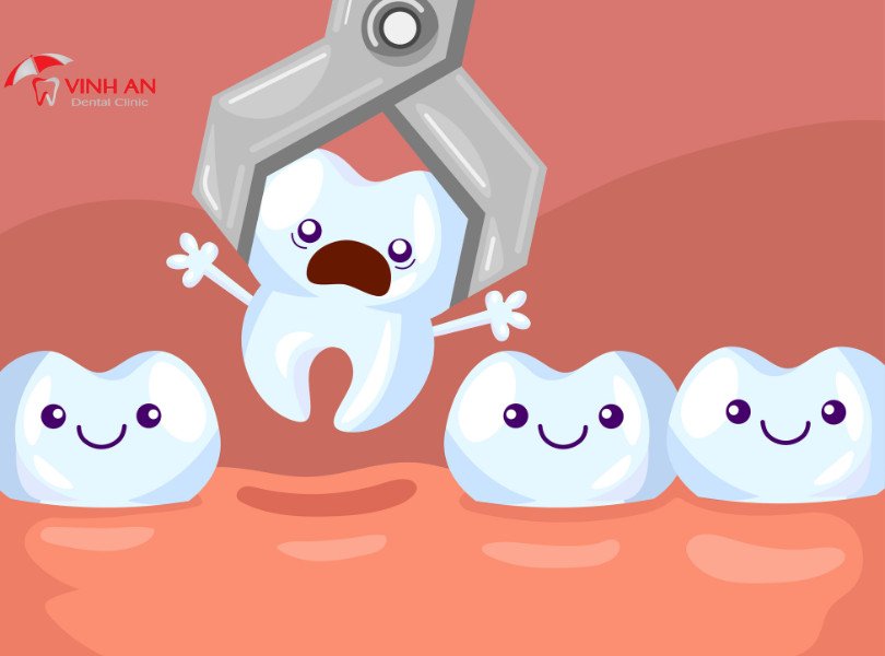 Ý nghĩa giấc mơ thấy răng lung lay và bị nhổ, sự bất an và quyết định khó khăn