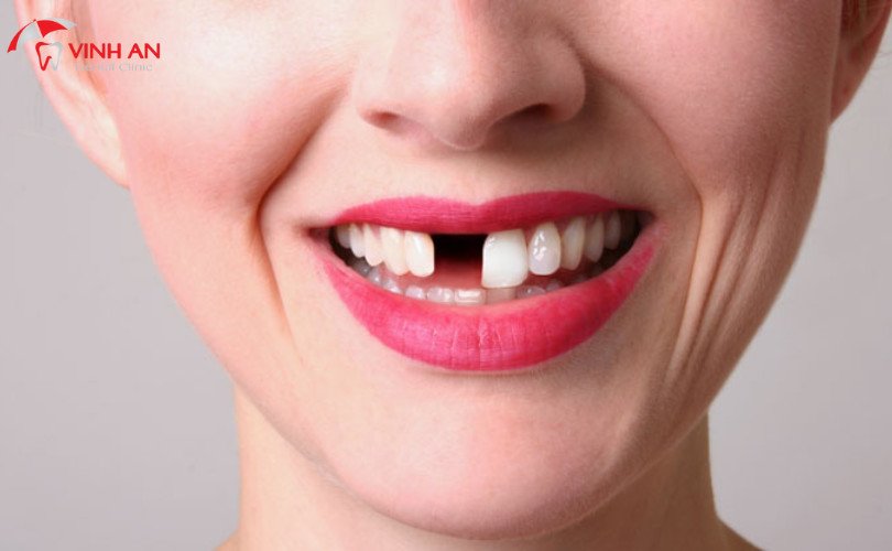 Ý nghĩa tốt xấu khi mơ thấy răng bị gãy