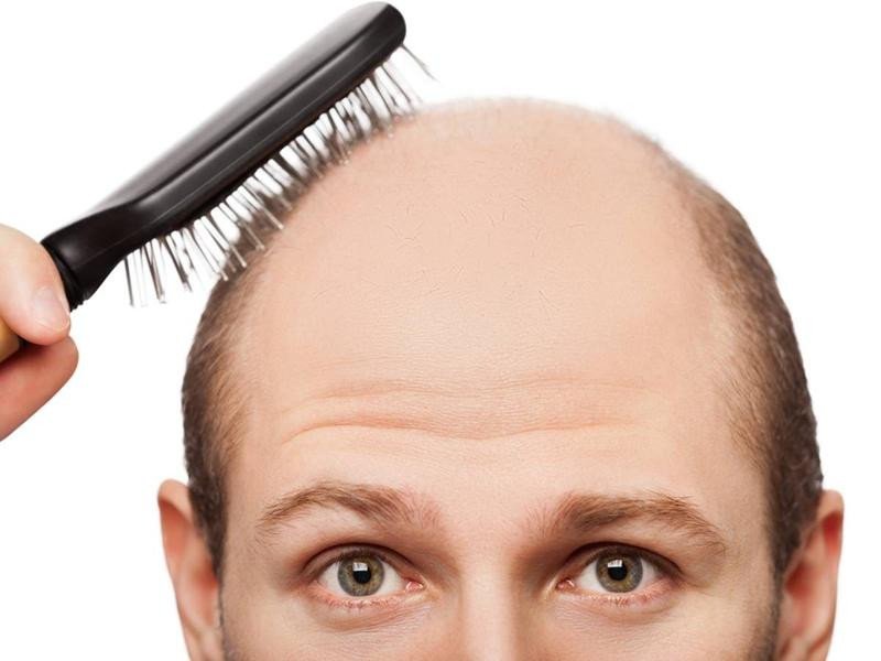 Mái tóc rụng khiến người phụ nữ lo lắng trong giấc mơ
