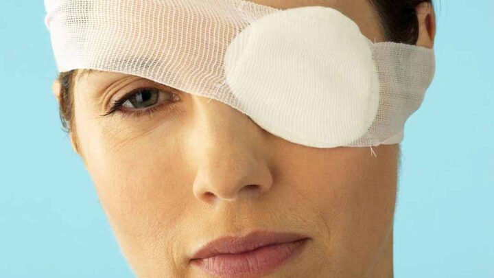 Mắt được băng gạc cẩn thận sau phẫu thuật thay thủy tinh thể